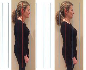 picture of forward head posture